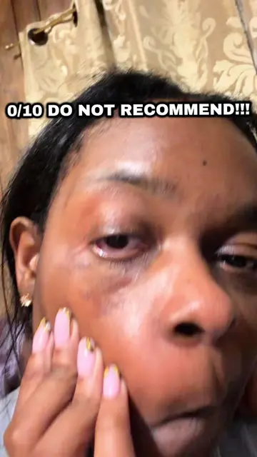 CHEMICAL BURN to the FACE!!!! Thanks to Garnier SkinActive Micellar Cleansing Wa