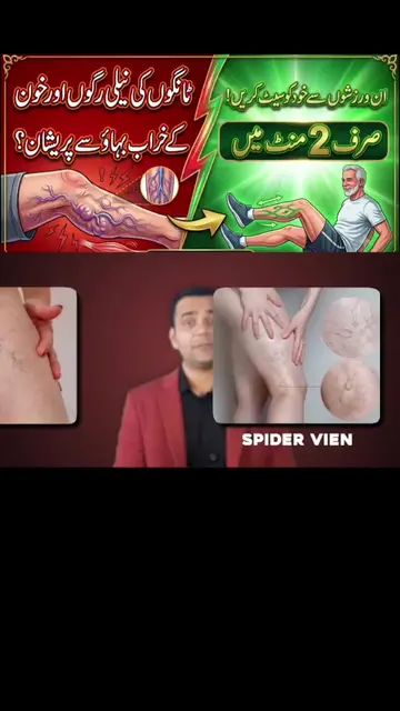 ​#VaricoseVeins ​#BloodCirculation ​#LegPain ​#ExerciseTips ​#HealthyLegs