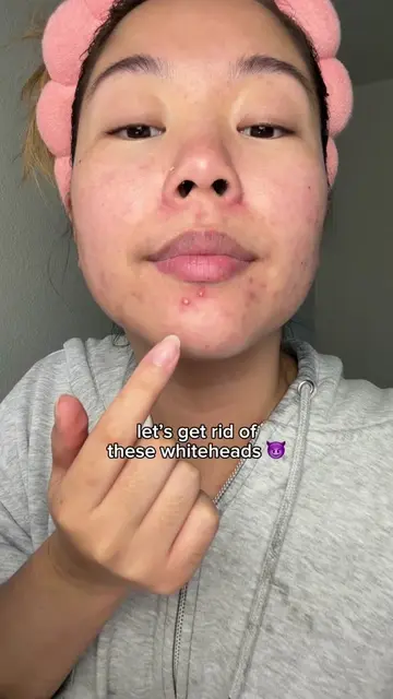 wow those were some juicy peels 🤩 #pimplepatch #acne #skincare #pimplepatchpeel
