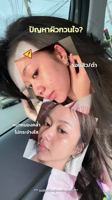 ปัญหาผิวกวนใจของสาวๆ มาจบด้วยสิ่งนี้กัน!!💛✨🍋 #GarnierThailand #เซรั่มวิตซี #คล