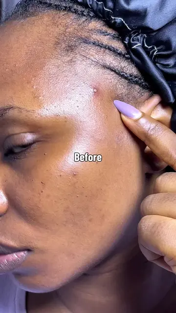 If you’re dealing with stubborn breakouts, lingering dark spots, or active redne