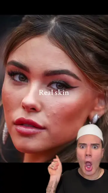 REMINDER THAT THIS IS REAL SKIN!🥰 #SkinCare101 #acnetips #acneprone #acneskinca