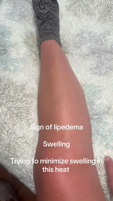 Heat + lipedema swelling = a combo I’m trying to manage this summer. 🥵🦵🏻 Heat