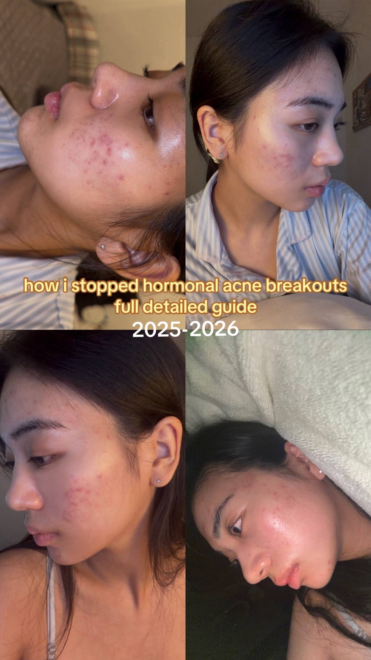 NOT SPONSORED‼️ here is what i did to clear my acne. ask me any questions 😁 #sk