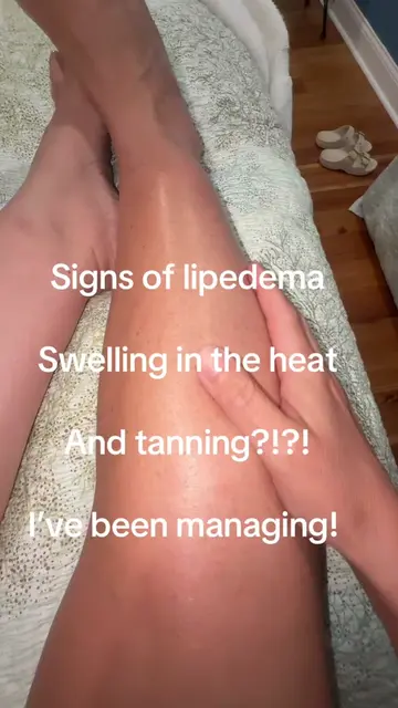Heat and the sun can cause tremendous swelling for lipedema legs. I’ve been doin
