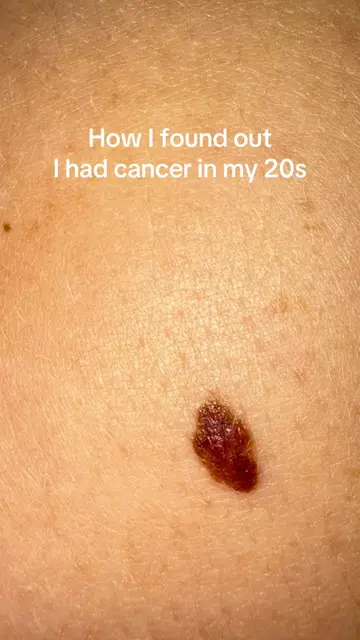 Melanoma is so much more than just skin cancer, Know your skin, know what’s norm