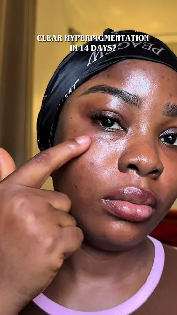 Clear skin unlocked✨🤍 Search "Dr. percent Dark sport Cream" on Amazon! @drperce