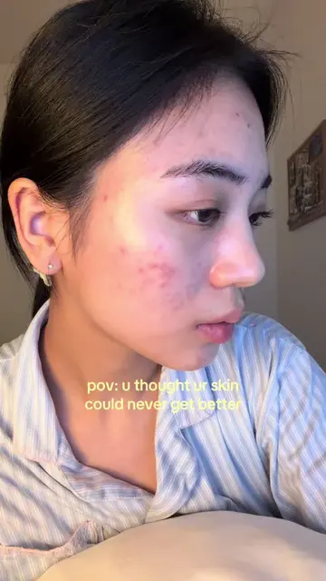 trust the process! #skincare #skin #skin #acnetreatment #tretinoin 