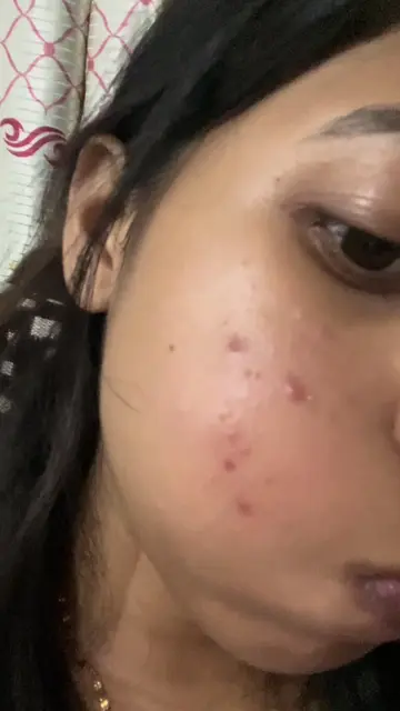 Acne didn’t just change my skin, it changed my life. There was a time when I hat