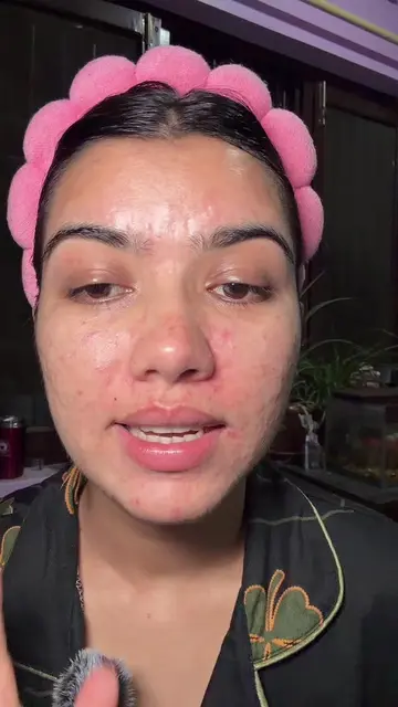 Its so frastuating 😭😭😭 #skincare #fyp #sensativeskin #acneprone #koreanskinca