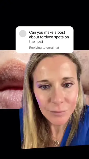 Do you have little white or yellow bumps around your lip line? Those are Fordyce