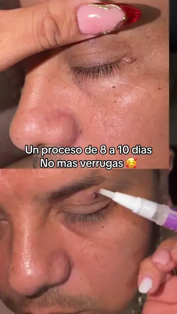No mas #verrugas #CuidadoDeLaPiel #SkinRepair #RemovedorDeVerrugas #PielBonita