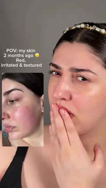 From visible redness & uneven texture to smoother, clearer-looking skin ✨ Loving