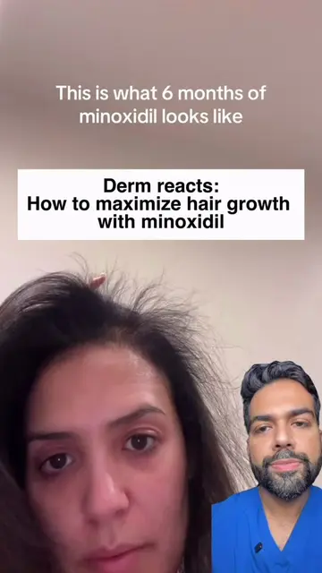 How to make the most out of minoxidil and grow your hair 🚀 (Keep away from pets