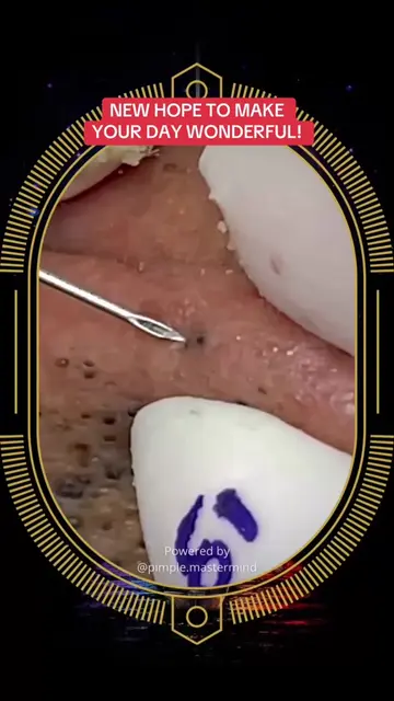 Blackheads removal at SPA Skincare Satisfying Video #blackheadsremoval #blackhea
