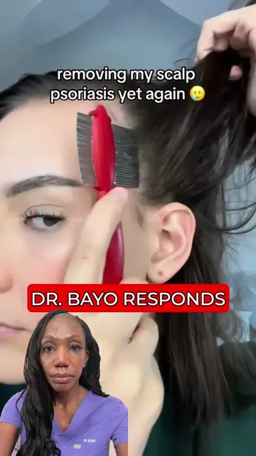 Thank you @hanna ♡ for sharing a glimpse at what it's like to live with scalp ps