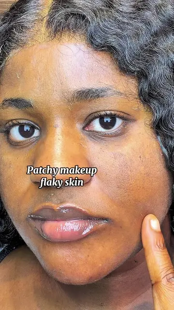 No Hyperpigmentation, No Bumpy Skin 🥰 @medicube global  #medicube  #hyperpigmen