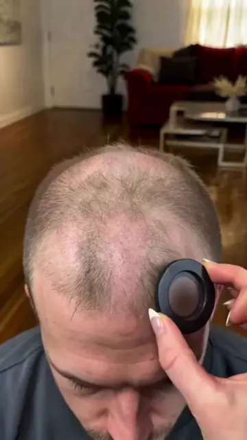 If you have thin hair and a visible hairline,and lack confidence every time you 