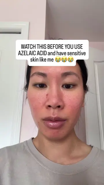 Don’t do what I did 😬 #azelaicacid #sensitiveskin #rednessproneskin #rosacea #s