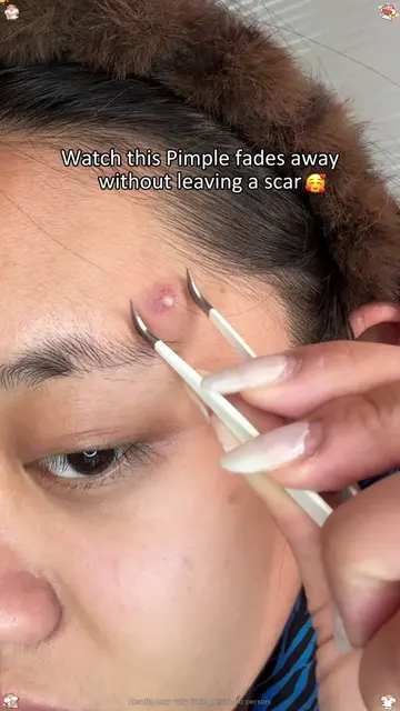 Watch this Pimple fades away without leaving a scar#acne #SalicylicAcid #acnetre