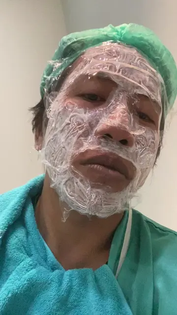 treatment di cellscience  #treatment #bopeng #acnescars #bopengtreatment #acnesc