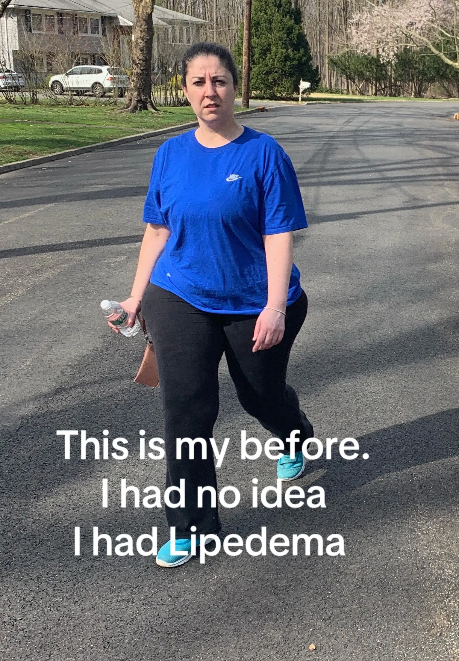 Living with lipedema