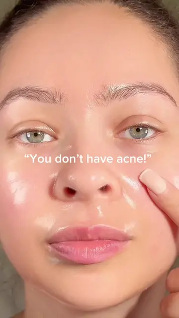 Acne healing 💞 #acne #pimples #clearskin #koreanskincare #acnetips 