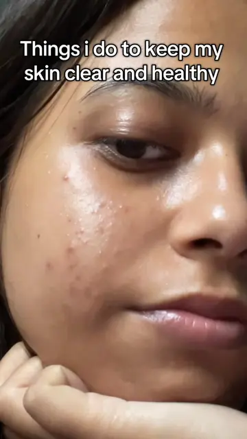 Things That Actually Helped Me Manage My Acne-Prone Skin As someone with acne-pr