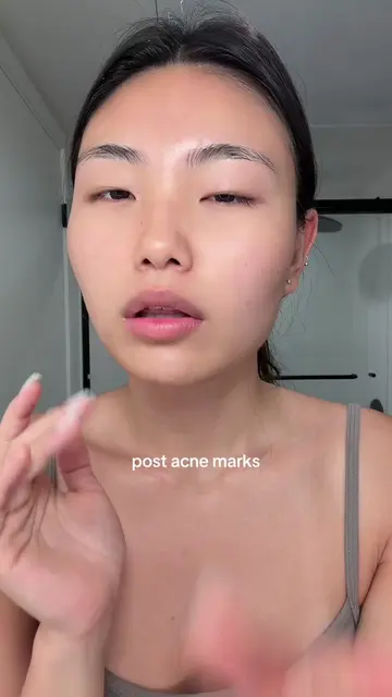 my tried and true @dear, Klairs EGF + Azelaic Acid method for post acne marks/PI