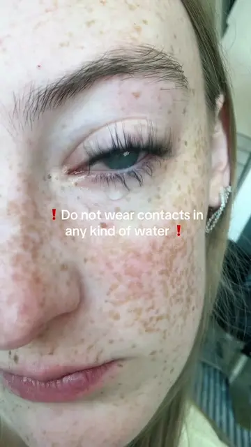 I went blind from showering with my contacts in. The Contacts trapped the ameoba