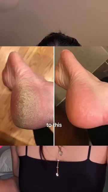Crusty rough dirty feet treatment 101👩🏻‍🏫 #koreanskincare #celimax #crustyfee