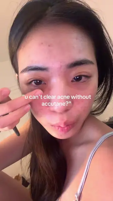 trust the process (and a really good barrier cream)😭✨ The tret + azelaic acid d