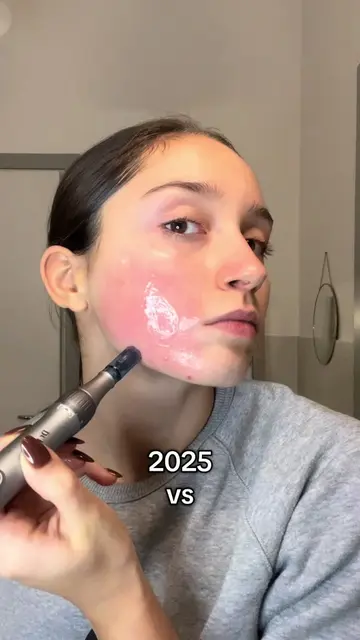 Almost a year into my microneedling journey—>consistency is what makes the diffe