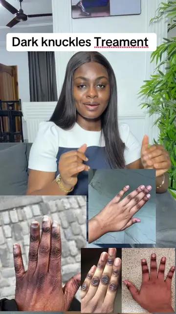 Dark knuckles caused by bleaching cannot be corrected with more bleaching or agg