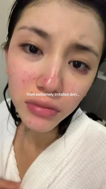 in a matter of weeks✨ @Arencia #arencia #acne #acnescars #vitaminc 