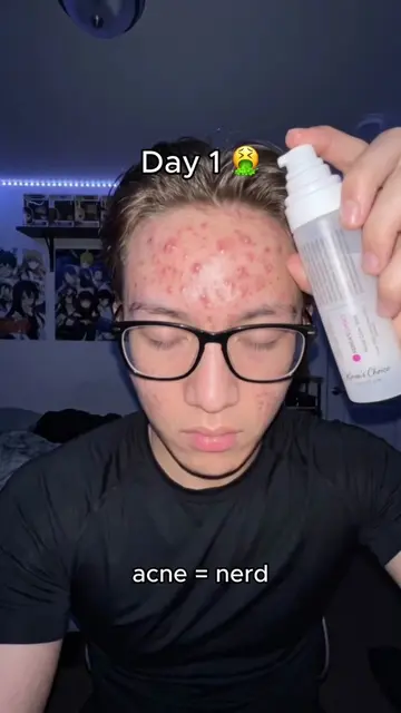 Acne = Nerd? 🧐  #acne #acnetreatment #acneproneskin #nerd 