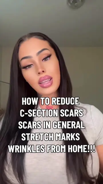 How to reduce scars, including C-section scars, acne scars, (all scars) stretch 