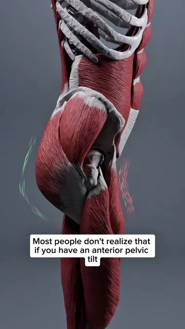 Most people don’t realize that an anterior pelvic tilt can make your stomach app