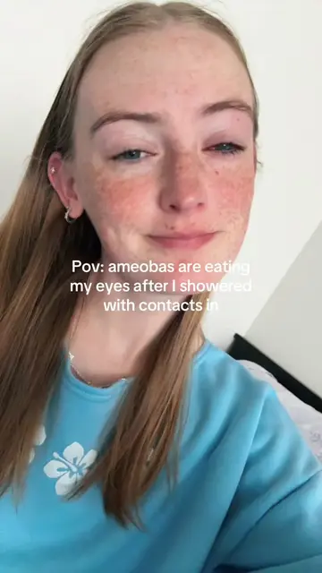 Showering with my contacts allowed the ameobas that live in all water called Aca