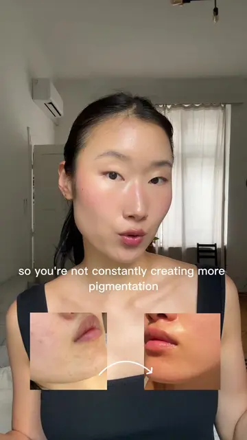 if you’re dealing with PIH (Post-Inflammatory Hyperpigmentation), here are some 