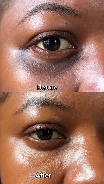 Best vitamin c cream for hyperpigmentation and dark under eyes  #hypeepigmentati