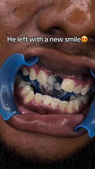 What are you waiting on to revamp your smile?👀 book now!  #fronttoothfilling #b