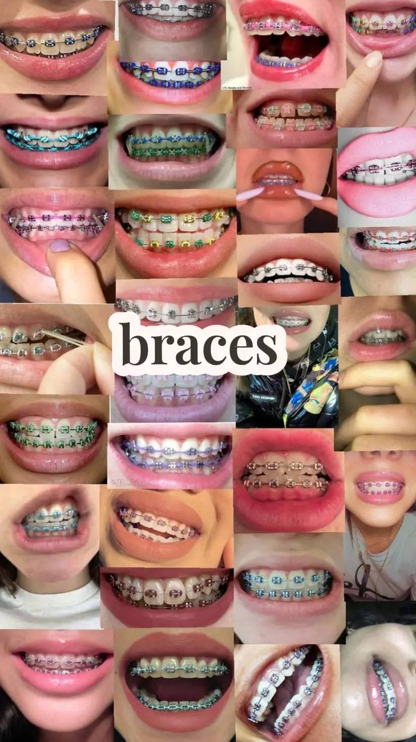 #braces #colours #idea #bracescolor 