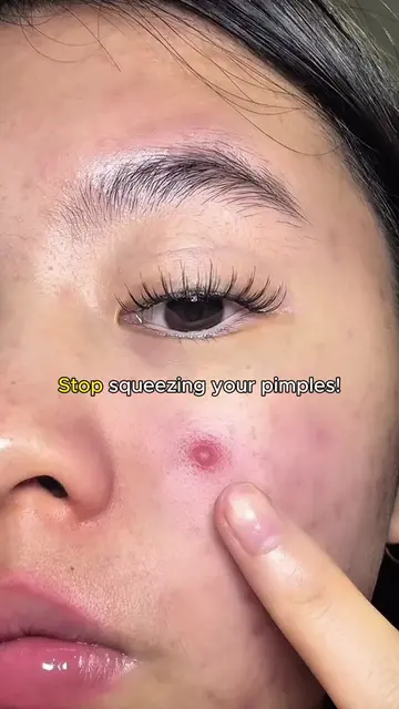 Stop squeezing your pimples! Tea tree oil cleared mine 7 days. Get your Amazon P