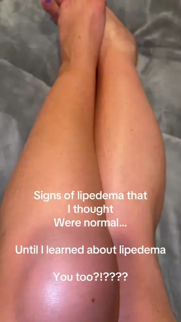 If you have lipedema, you may have noticed some of these signs 👀 • Less hair on