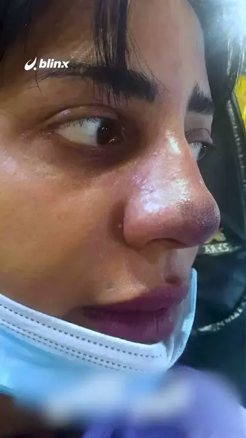 حقنة فيلر لتجميل أنفها انتهت بتنخر الأنسجة وحاجتها لـ5 عمليات ترميم! فما الذي يج