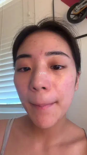 it took me over a year to figure out 😭  #skincare #skin #acne #acnetreatment #t