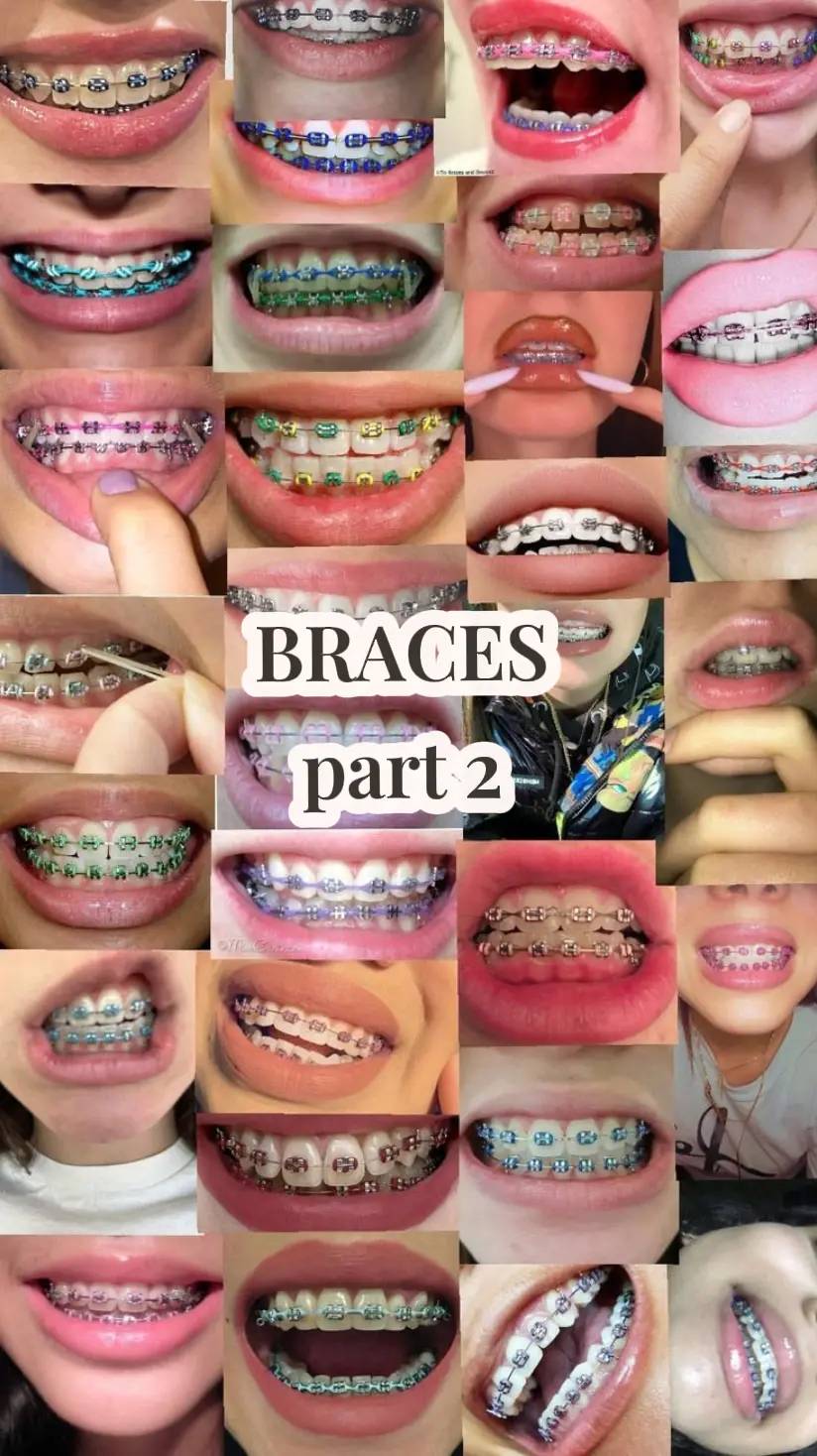#braces #colours #fypbraces #orthodontics @✞🪼ྀིྀི𝓙𝓸𝓱𝓪𝓷𝓷𝓪🪼ྀིྀི✞ 