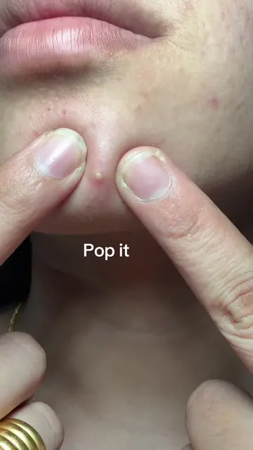 Saying goodbye to early-stage blemishes with a little magnesium microdart magic.
