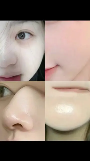 Acne scars, pitted skin, and yellowing pigmentation ✨This niacinamide is such a 